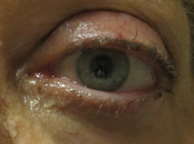 Upper Eyelid Surgery – Eye Care – Kayvan Keyhani MD, MPH